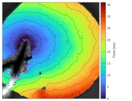 Activation map of hiPSC-CMs